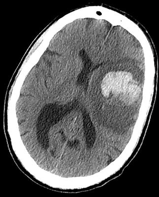 Seizures, Edema, Thrombosis, and Hemorrhages: An Update Review on the Medical Management of Gliomas